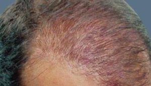Clínica Capilart Cirurgia da Calvície em Brasília