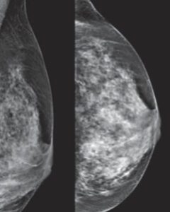Imagem Integrada Ultrassonografia mamária “second look” ou direcionada no Rio de Janeiro