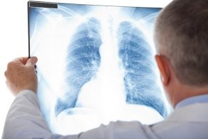 Dr Rafael Klas Rocha Leal Fibrose pulmonar em Curitiba