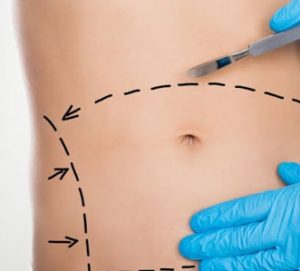 Dr Flavio Rezende Abdominoplastia em Cabo Frio